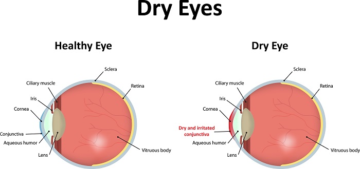 Dry Eye and Ocular Surface Syndrome